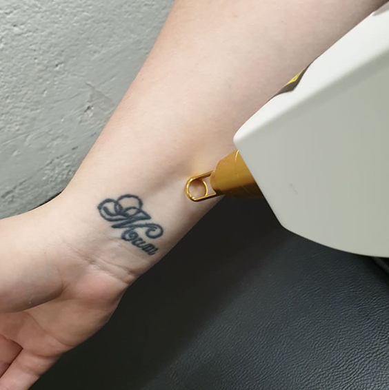 image of laser tattoo removal specialist