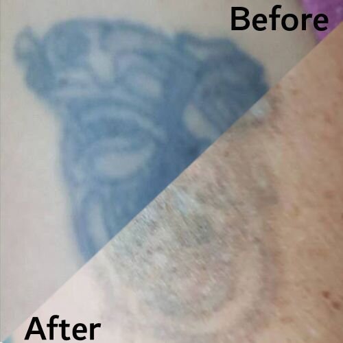 image of laser tattoo removal proces 