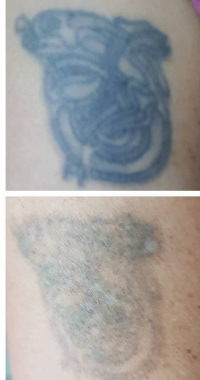 tattoo removal,Dublin tattoo removal, laser tattoo removal
